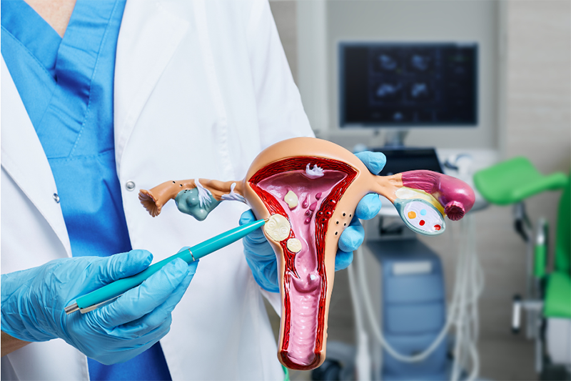 Uterine fibroids schematic image